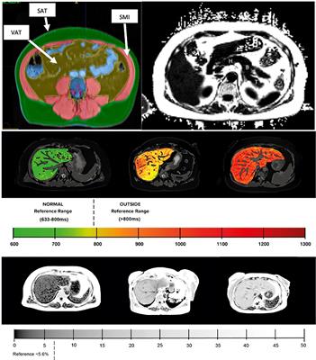 Poor glycaemic control and ectopic fat deposition mediates the increased risk of non-alcoholic steatohepatitis in high-risk populations with type 2 diabetes: Insights from Bayesian-network modelling